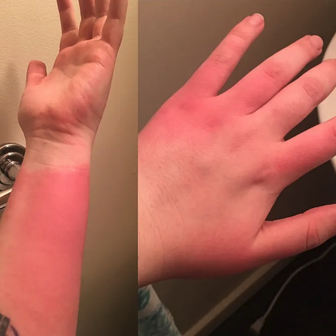 Two pictures side by side of a forearm and hand, red and inflamed; you can see a white band around the wrist where the watch was when I was pepper sprayed